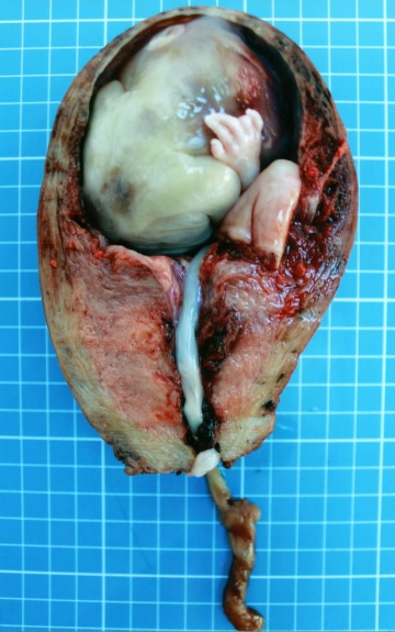 Acretismo Placentario